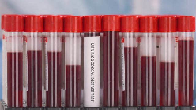 Laboratory worker wearing protection glove puts laboratory tube with meningococcal disease test in the tube rack