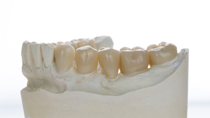 excellent zirconium crowns in the dental model, shot on a white bright background