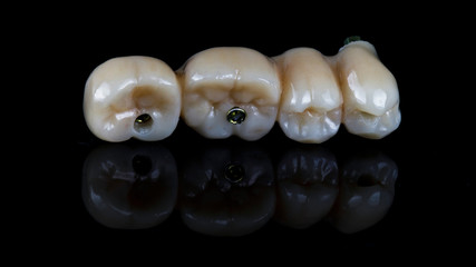 zircon bridge for fixation on three implants in the chewing part, tooth morphology is shown