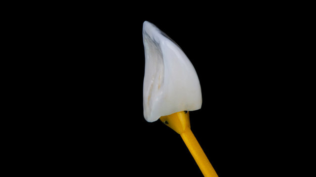 thin front tooth veneer, incisal side view