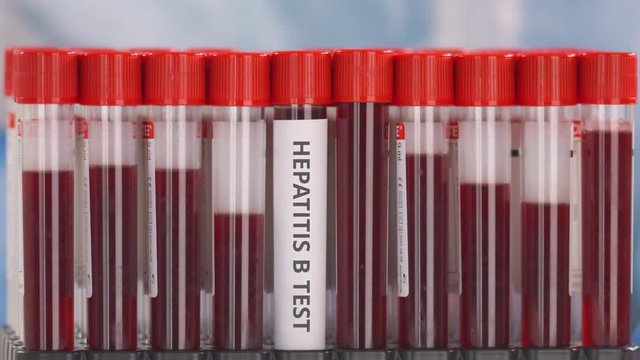 Hand wearing protection glove puts vial with hepatitis B test in the tube rack