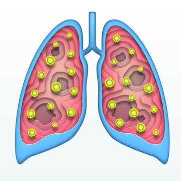 Affected Human Lungs With Covid Virus Within. Deep Paper Layered Cut Out Art In Origami Style. Vector Illustration Of Coronavirus Disease.