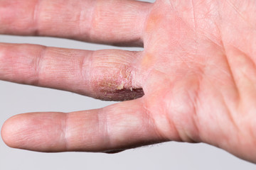 Finger with psoriasis disease
