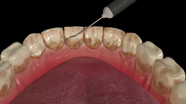 Dental Scaling Procedure