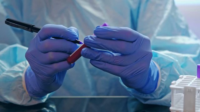 Coronavirus epidemic. Laboratory analysis. Nurse in gloves marking blood sample in tube.
