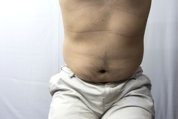 Naklejka premium Fat man Risk of diabetes.
