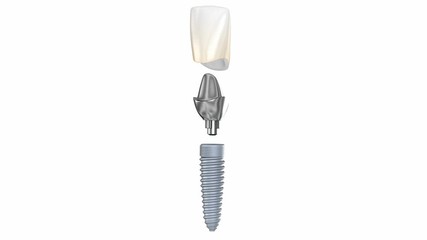 Ceramic crown, custom implant abutment and implantat instalation process. Medically accurate 3D animation of dental implantation