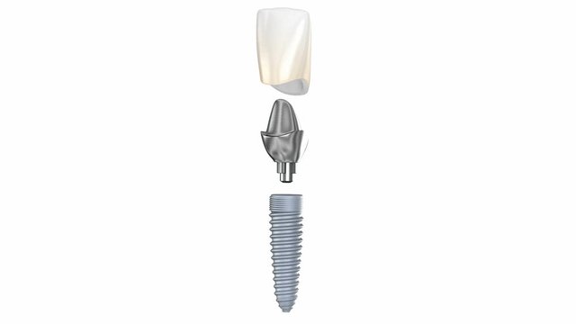 Ceramic crown, custom implant abutment and implantat instalation process. Medically accurate 3D animation of dental implantation