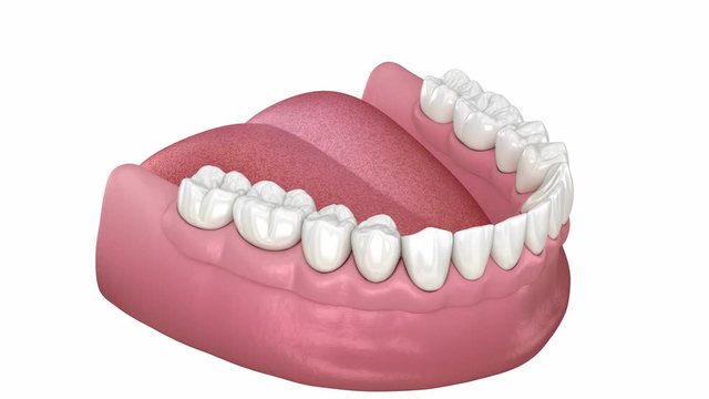 Mandibular prosthesis with gum All on 6 system supported by implants. Medically accurate 3D animation of human teeth and dentures concept