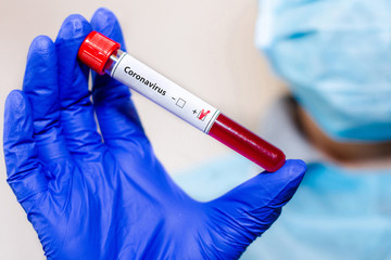 Medical laboratory assistant holding test tube with positive Coronavirus test blood sample.