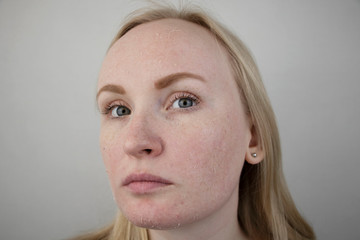 A woman examines dry skin on her face. Peeling, coarsening, discomfort, skin sensitivity. Patient...