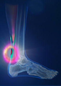 Achillessehne, Schmerzzone, Illustration, Computertomographie