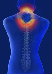 Rücken, Halswirbelsäule, Schmerzzone, Illustration, Computertomographie
