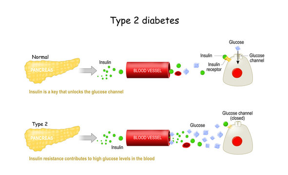 Types 2 of Diabetes Mellitus. Comparison of cell work in diabetes and in a healthy body.