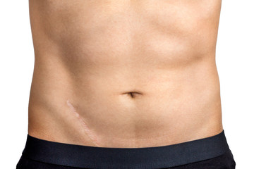 Fototapeta na wymiar Man body with scar isolated on white. Scar on abdomen after surgery on abdomen, removal of appendicitis.