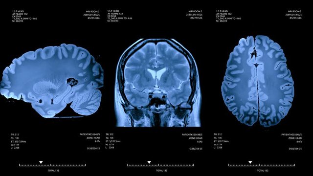 Brain scan screen animation. Diagnosis medical data