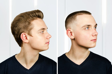 man before arter haircut with hair loss: bald and pompadour, transplant and transformation in profile fade side
