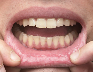 Mouth with healthy teeth