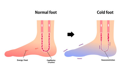 Comparison illustration of normal foot and cold foot ( sensitivity to cold, cold toes)