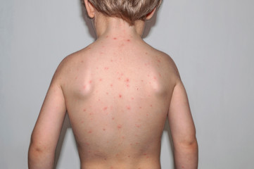 Naklejka premium Chickenpox disease. Boy sick on his back . Chickenpox virus, chicken pox outbreak in children. Concept of contagion.