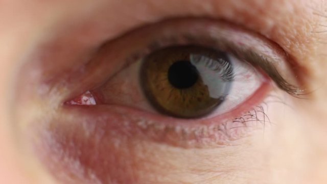 Macro view of a man's eye with contact lens for keratoconus for a medical concept