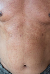 Naklejka premium Rash that occurs on the skin due to allergy symptoms