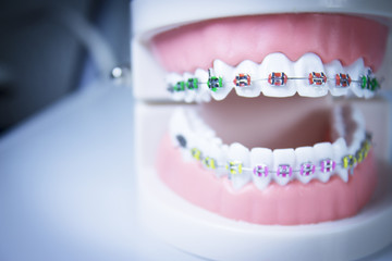 Model denture with metal orthodontics