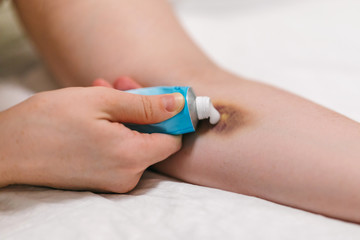 First aid for bruising. Large hematoma bruise on the arm, ointment and bandage
