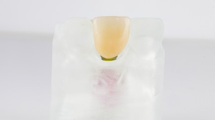 temporary crown made of highly accurate polymer on a model made in a 3D printer