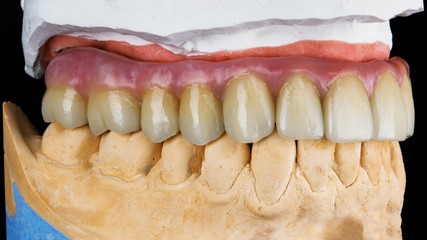 quality dental prosthesis for the upper jaw on a model of plaster