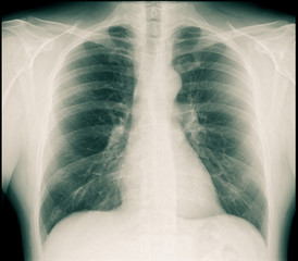 X-ray view of longs and chest