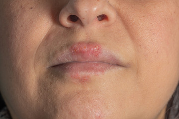 Allergic reaction to metal on the lips of a middle-aged white woman