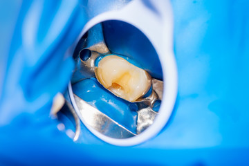 close-up treatment of a human tooth using a blue rabberdam system and a dental mirror. Aesthetic dentistry, hygiene