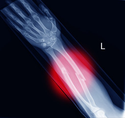 Fracture Forearm on red mark.