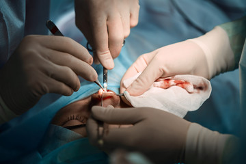 A surgeon with gloves is operating on his nose. Rhinoplasty, close-up operation. Blue light, teamwork, health, beauty.