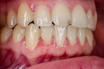 plaque induced gingivitis
