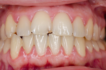 plaque induced gingivitis