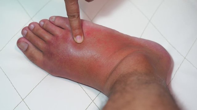 Close up old man right foot, Ankle wounded waiting and swelling infectious disease by bee sting allergic reactions nurse treatment on wound dressing a finger touch press nursing on white background.
