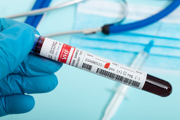 Fototapeta premium Blood samples with infected virus