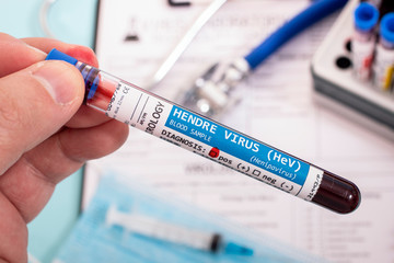 Fototapeta premium Blood samples with infected virus