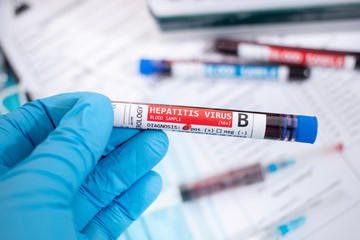 Fototapeta premium Blood samples with infected virus