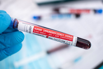 Fototapeta premium Blood samples with infected virus