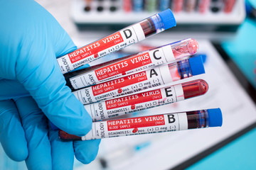 Fototapeta premium Blood samples with infected virus