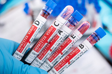 Fototapeta premium Blood samples with infected virus