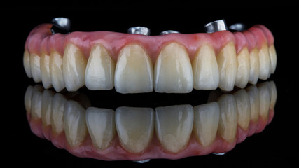 dental prosthesis made of titanium with beautiful and high-quality ceramic or zircon crowns, shot...