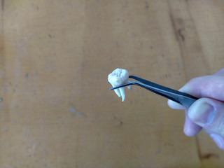 Removed tooth in tweezers in the dentist's office © Alex Milan