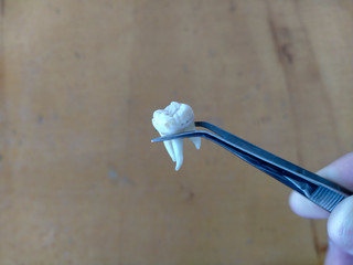 Removed tooth in tweezers in the dentist's office © Alex Milan