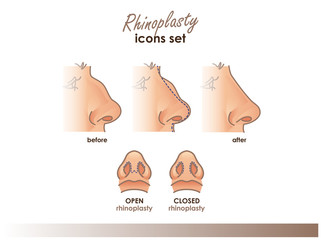 Rhinoplasty. Open and closed rhinoplasty. Side and bottom view. Plastic surgery nose. Medical and beauty illustration