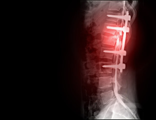 myelography is particularly sensitive at detecting small disk herniations compressing nerves of the...