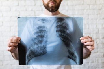 Young bearded man holding X-ray film of lungs in front of his chest